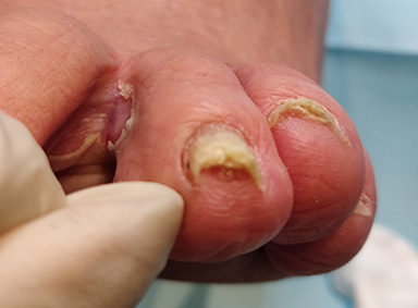 Voetschimmel Rood Tussen De Tenen